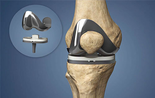 Total Knee Replacement