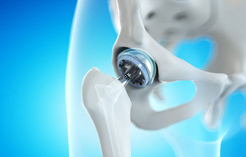 Total Hip Replacement