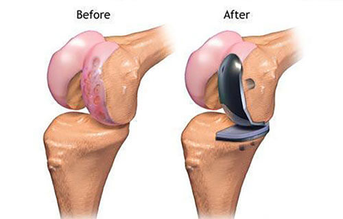 Partial Knee Replacement