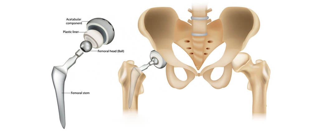 Total Hip Replacement