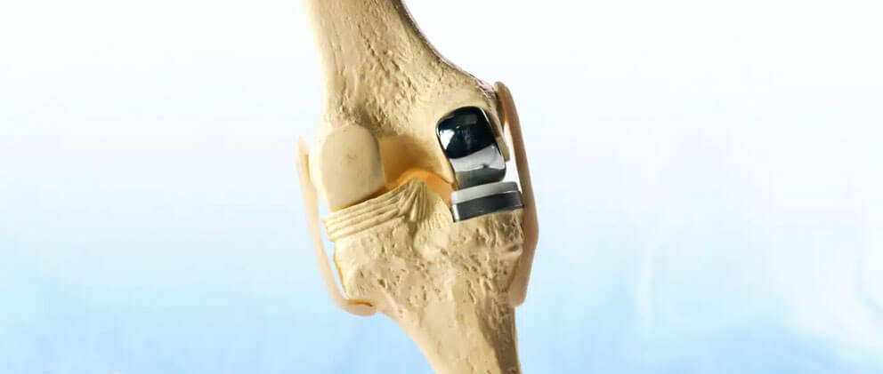 Partial Knee Replacement